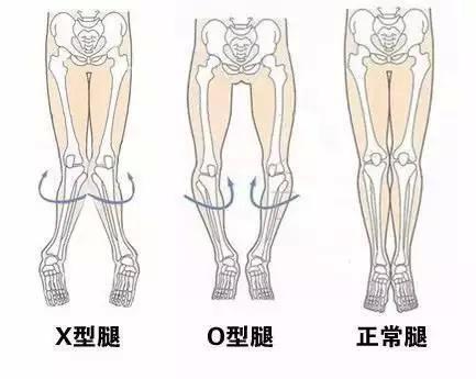 宝宝腿为啥是弯的？怎样判断是否O型腿或X型腿