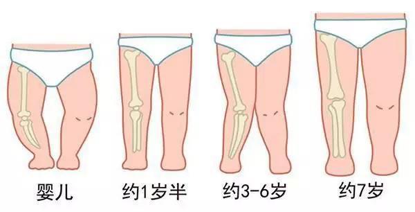 宝宝腿为啥是弯的？怎样判断是否O型腿或X型腿